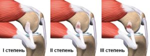 Растяжение связок коленного сустава сроки восстановления