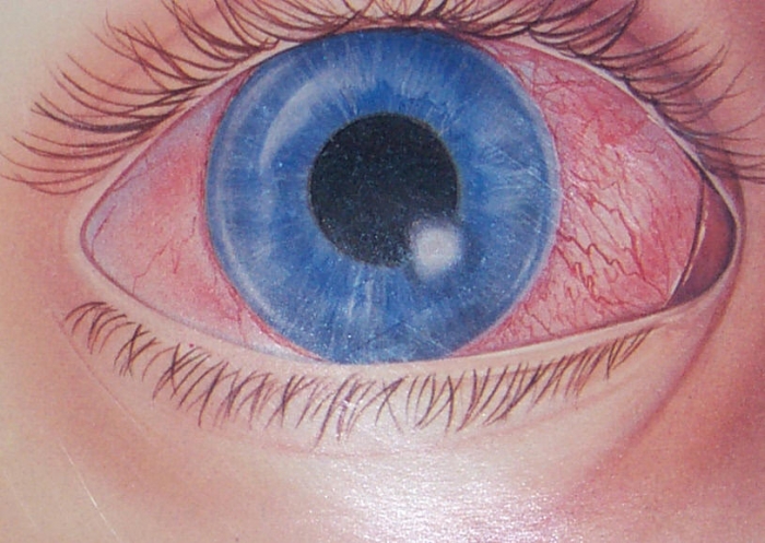 Кератит глаз