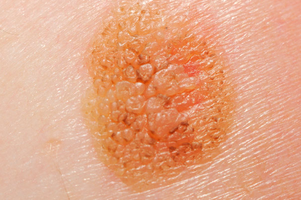 Меланома – как вовремя распознать рак кожи?