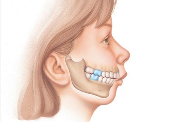 Дистальный прикус, фото до и после брекетов, исправление и лечение мезиальной, глубокой неправильной формы зубов у взрослых