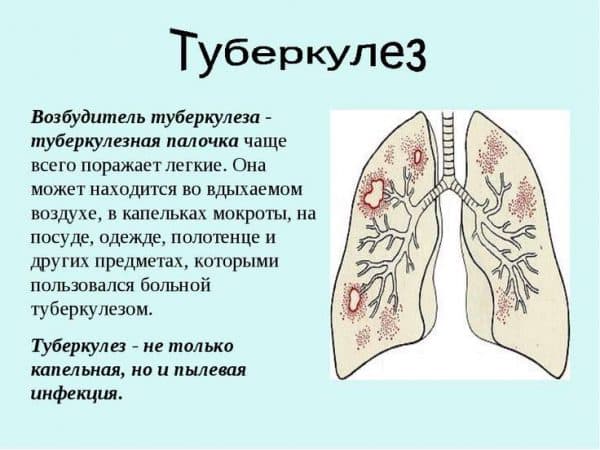 Фиброзно кавернозный туберкулез легких
