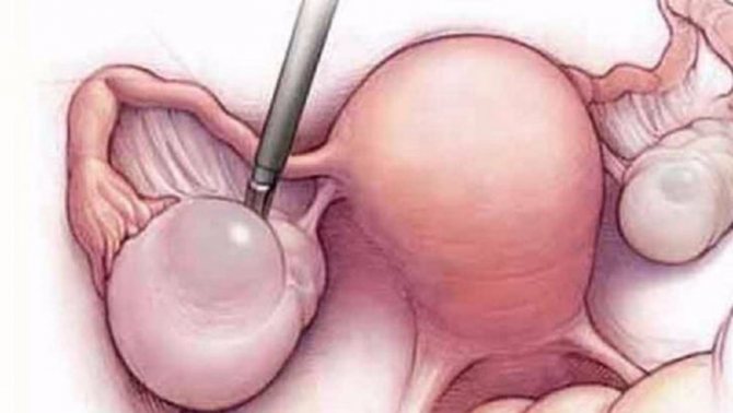 Диета после лапароскопии кисты яичника и удаления матки: меню, отзывы и результаты
