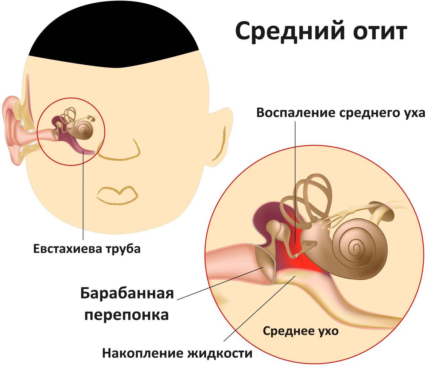 Болит ухо у взрослого при простуде