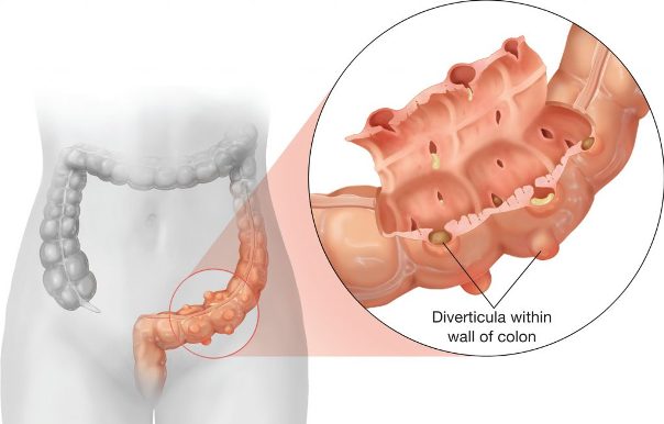 Дивертикулёз толстой кишки — тяжёлые последствия бессимптомной болезни