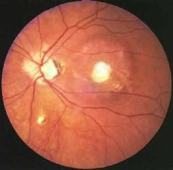 Хориоретинит глаза: что это такое, виды (центральный серозный, токсоплазмозный, туберкулезный, сифилитический, острый, очаговый), причины, симптомы, лечение, диагностика, осложнения, берут ли в армию