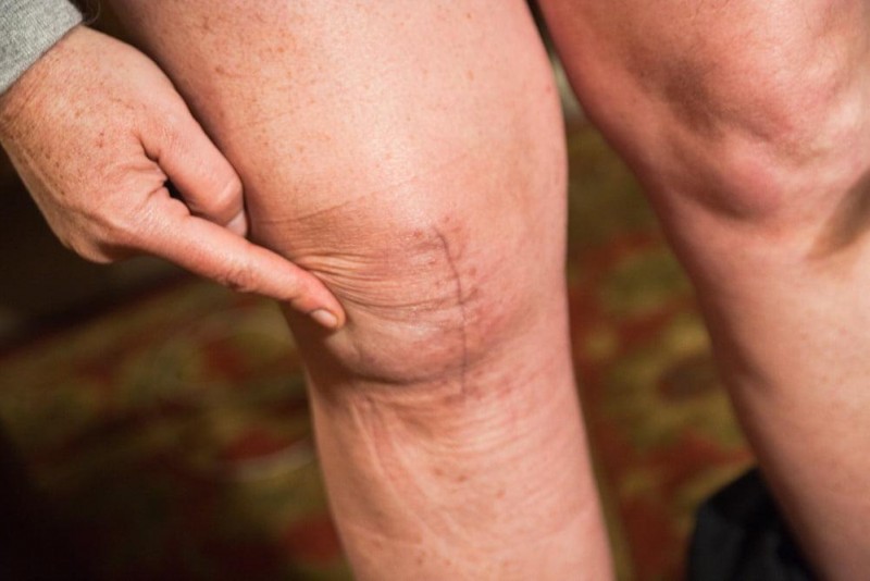 Замена, эндопротезирование коленного и тазобедренного сустава
