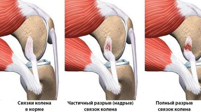 Растяжение связок коленного сустава: причины, симптомы и лечение