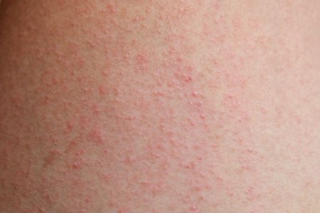 Аллергический дерматит у детей: как правильно лечить, какие симптомы и причины заболевания