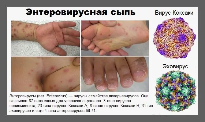 Профилактика энтеровирусной инфекции