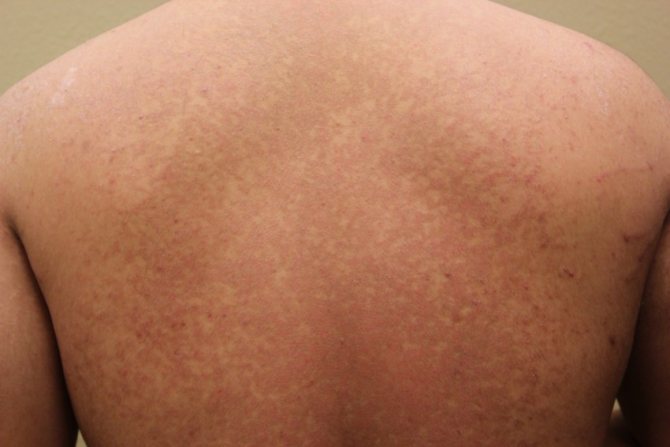 Разновидности грибковых заболеваний кожи у человека