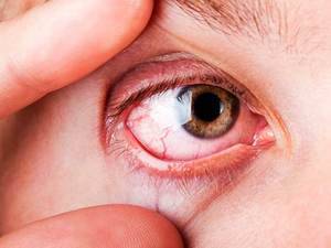 Эписклерит глаза: причины, симптомы и лечение заболевания препаратами детей и взрослых, код мкб-10