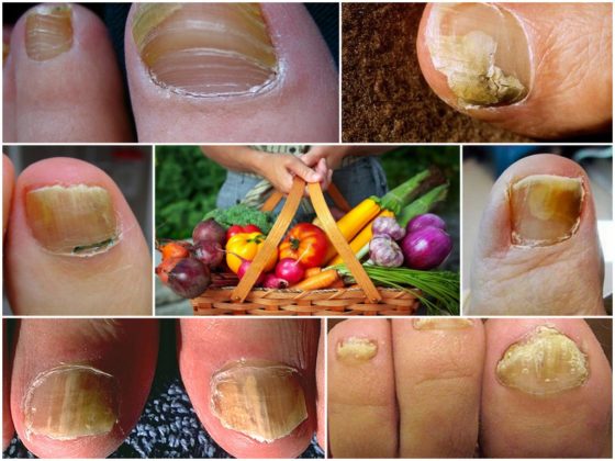 Диета при грибковых заболеваниях кожи и ногтей
