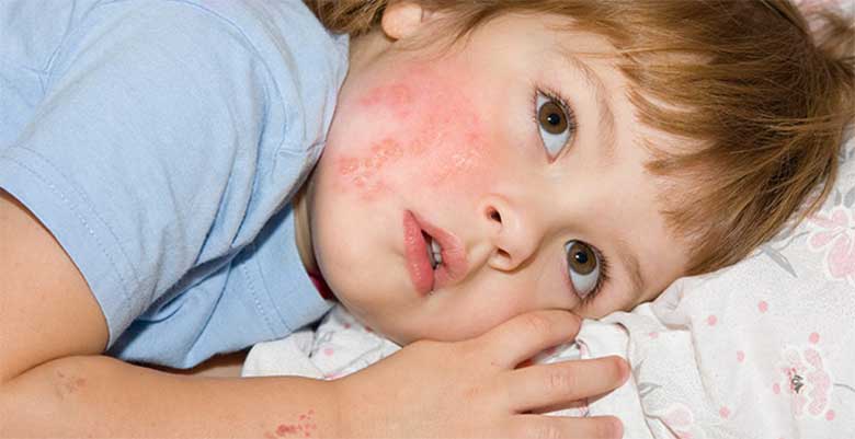 Себорейный дерматит у детей: причины, симптомы, методы лечения
