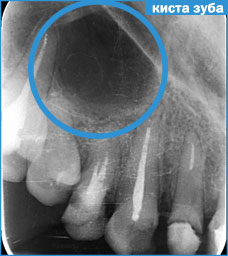 Причины появления гранулемы зуба и тактика ее лечения
