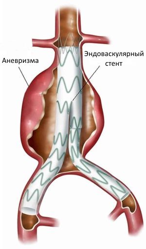 Аневризма грудной аорты. симптомы, диагностика и лечение патологии