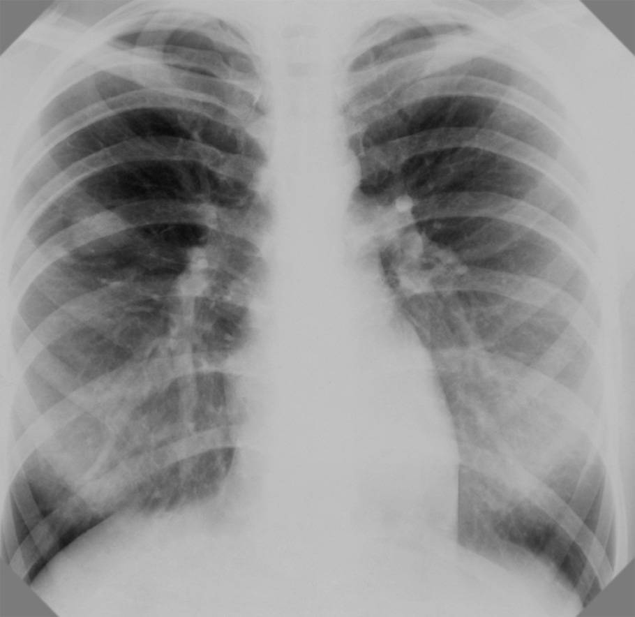 Рентген при туберкулезе. симптомы, признаки, описание рентгена при пневмонии