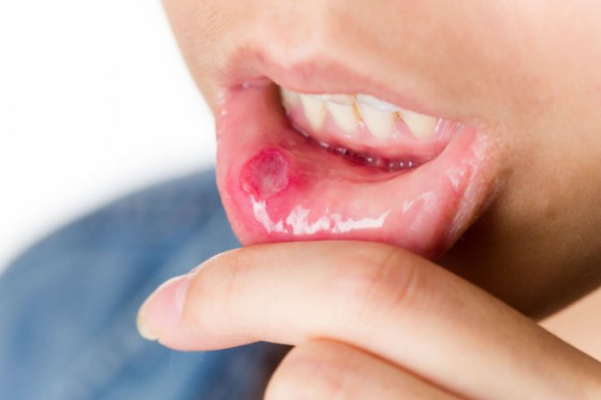 Почему во рту часто появляются язвочки
