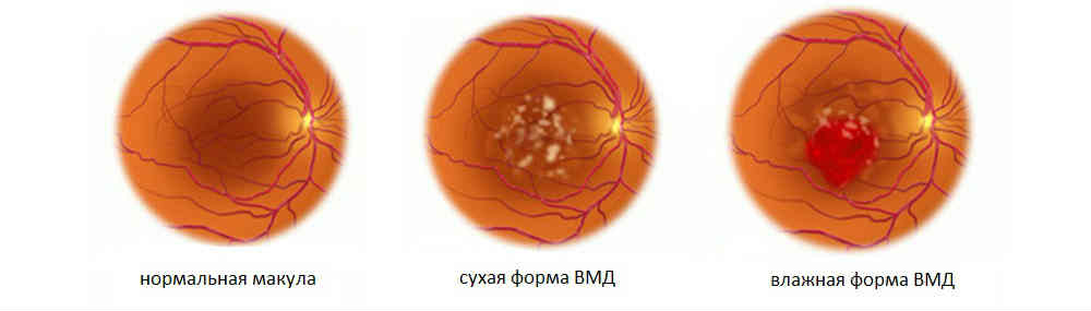 Причины и симптомы макулодистрофии сетчатки глаза
