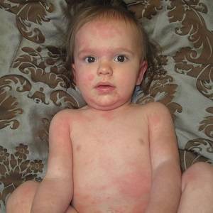 Аллергия на клубнику у ребёнка и взрослого: симптомы, фото, лечение и профилактика аллергической реакции