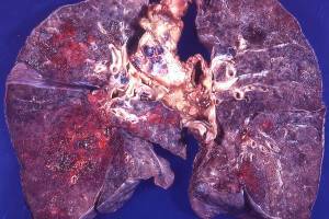 Туберкулез органов дыхания с широкой лекарственной устойчивостью у взрослых