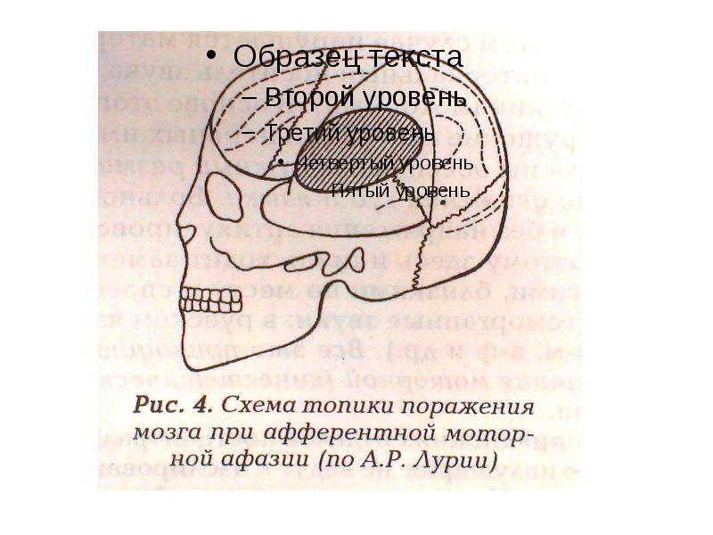 Афферентная и эфферентная моторная афазия. Разрезные азбуки афазия.