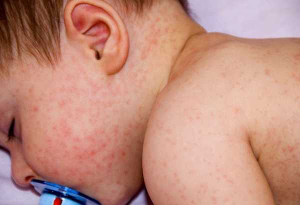 Как выглядит аллергия на манту у ребенка?