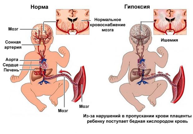 Гипоксия плода: симптомы, признаки, причины, лечение и последствия внутриутробной гипоксии плода