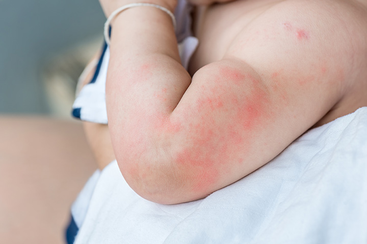 Крапивница у детей — не приговор! как правильно лечить заболевание аллергического характера?