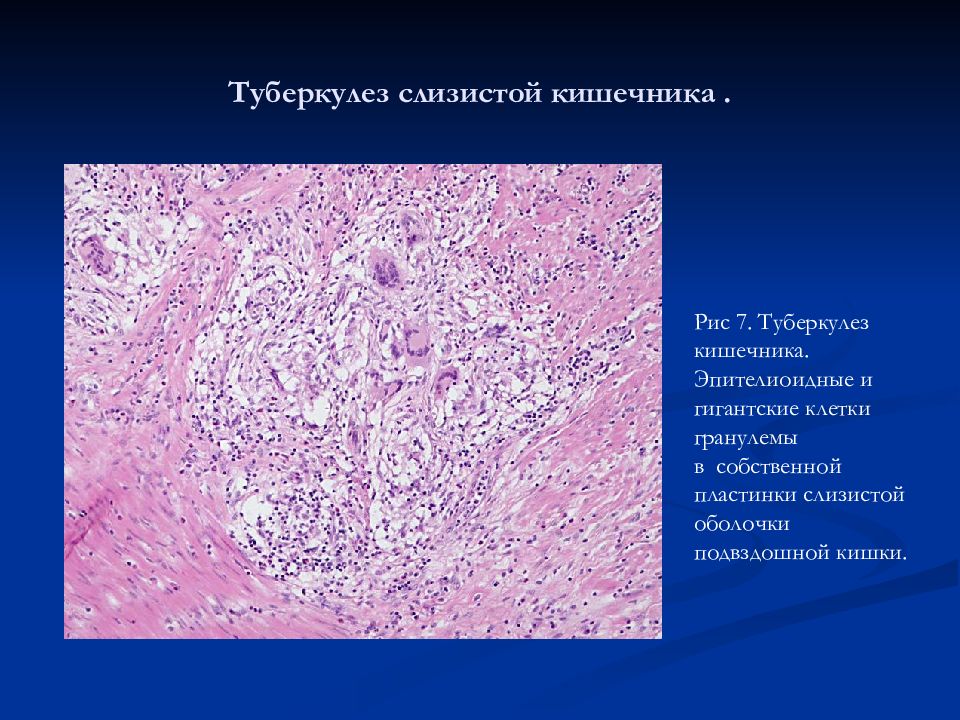 Туберкулез кишечника картинки