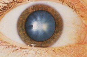 Глазная мигрень или мерцательная скотома: в чем причина и как лечить