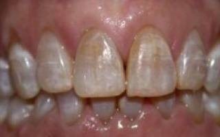 Настоящие зубы. ученые смогли восстановить эмаль - korrespondent.net