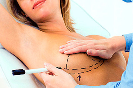 Пластика груди (маммопластика): показания, виды и методы, проведение, восстановление после