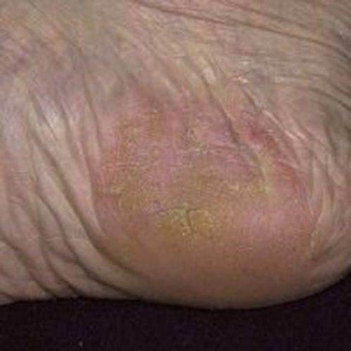 Как избавиться от дерматита на ногах