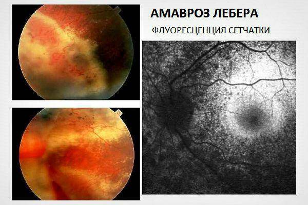 Что такое амавроз глаза: симптомы и лечение