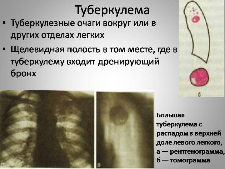 Как передается туберкулез от человека к человеку. очаговый туберкулез легких: заразен или нет, лечение, симптомы, сколько лечиться и как передается