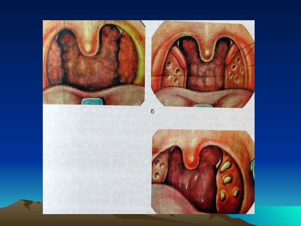 Обостренный хронический тонзиллит фото
