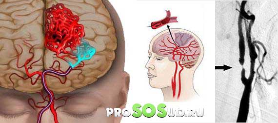 Арахноидальная киста головного мозга: симптомы, лечение