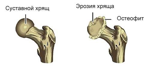 Удалить остеофиты на позвоночнике