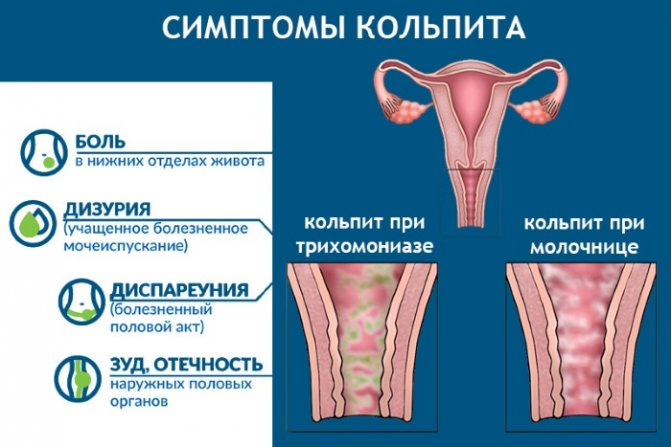 Вагинит (кольпит) – причины и симптомы. таблетки, капсулы, свечи и гели в лечении вагинита. чем лечить кольпит у женщин во время беременности