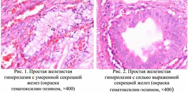 Железистая гиперплазия эндометрия