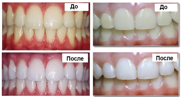 Отбеливание зубов: вред и польза самых действенных методов