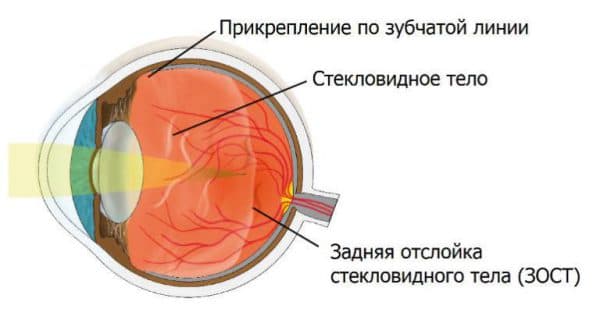 Лечение кровоизлияния в стекловидное тело, в глаз