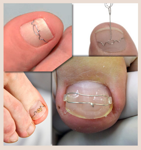 Лечение вросшего ногтя на большом пальце ноги в домашних условиях народными средствами. онихокриптоз.