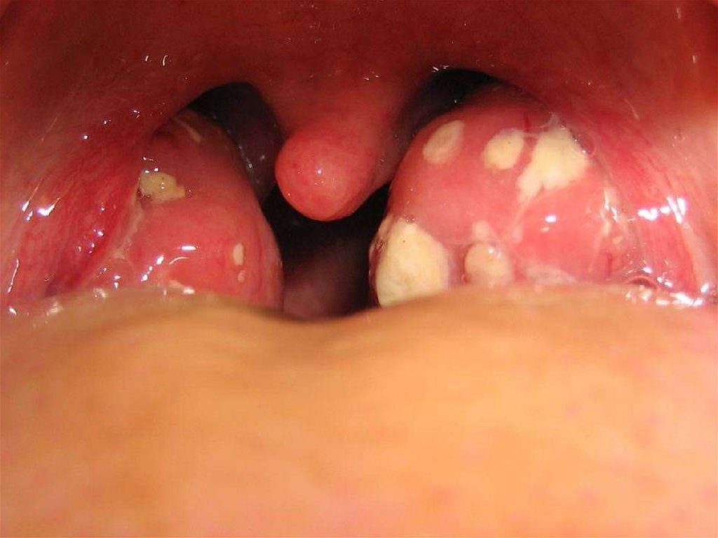 Грибок в горле и дыхательных путях: симптомы и народные способы лечения