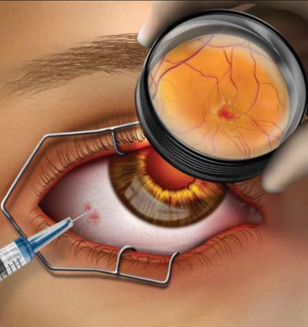 Народные средства лечения при дистрофии макулы глаза