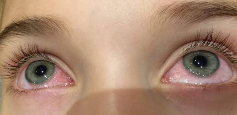 Капли глазные детям от аллергии