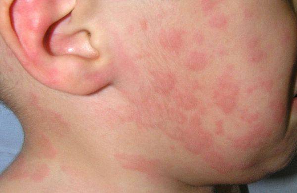 Аллергия на огурцы