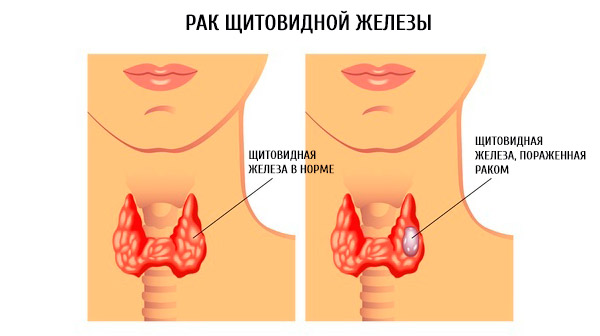 Узловой зоб щитовидной железы - лечение, симптомы, степени тяжести, народные средства в лечении заболевания - docdoc.ru