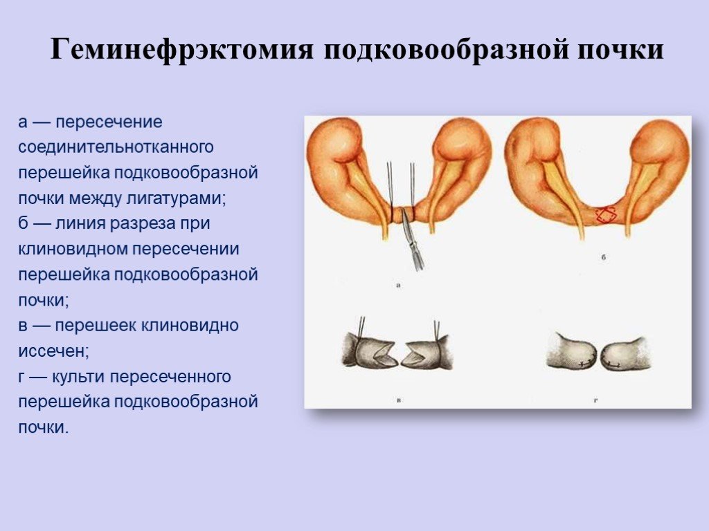 Подковообразная почка у ребенка чем опасна