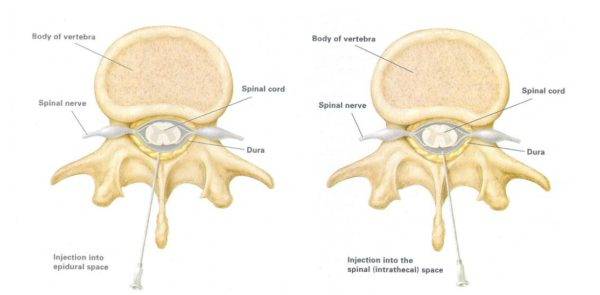 Болит спина после эпидуральной анестезии причины лечение